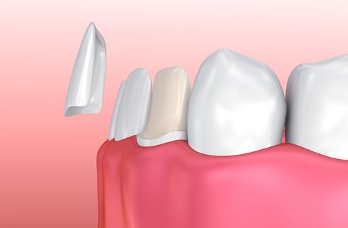 Dental Veneers - Cosmetic Dentist in Dublin