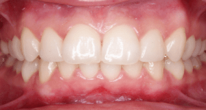 teeth whitening dublin