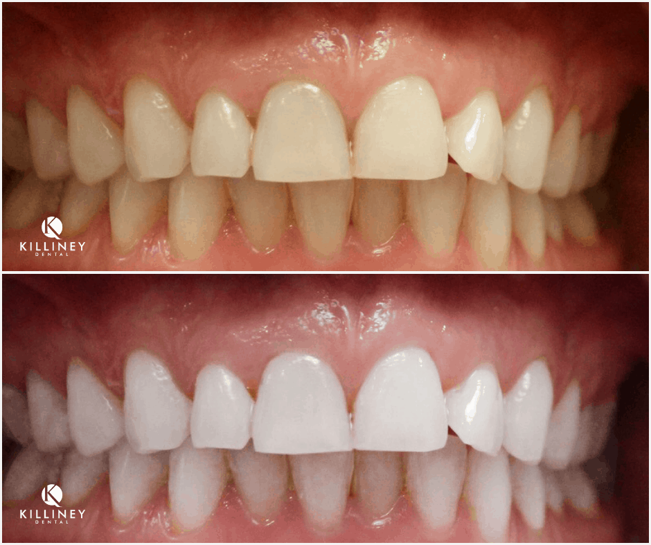 teeth whitening dublin
