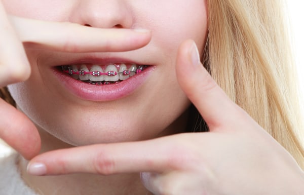 Myths About Having Braces As An Adult