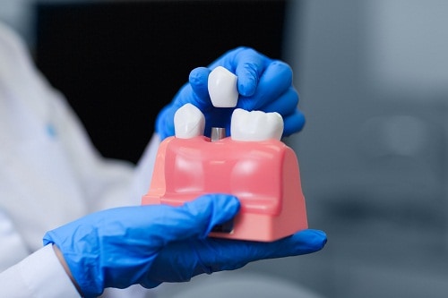 Know Which Dental Implants Are Suitable For You?