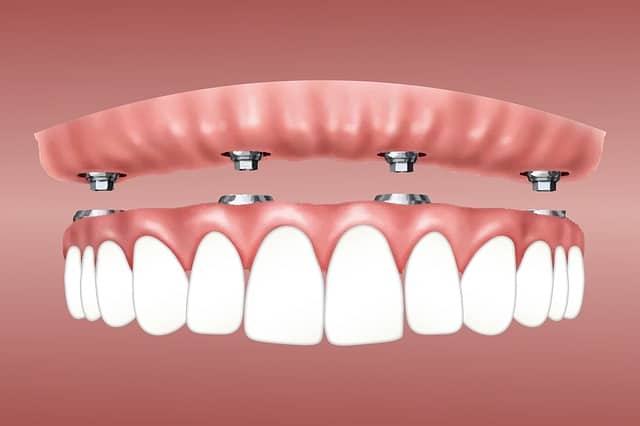 What Are The Benefits of Dental Implant Dentures?